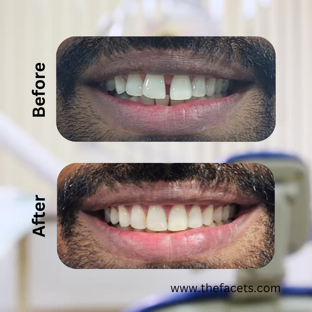 Before After 4